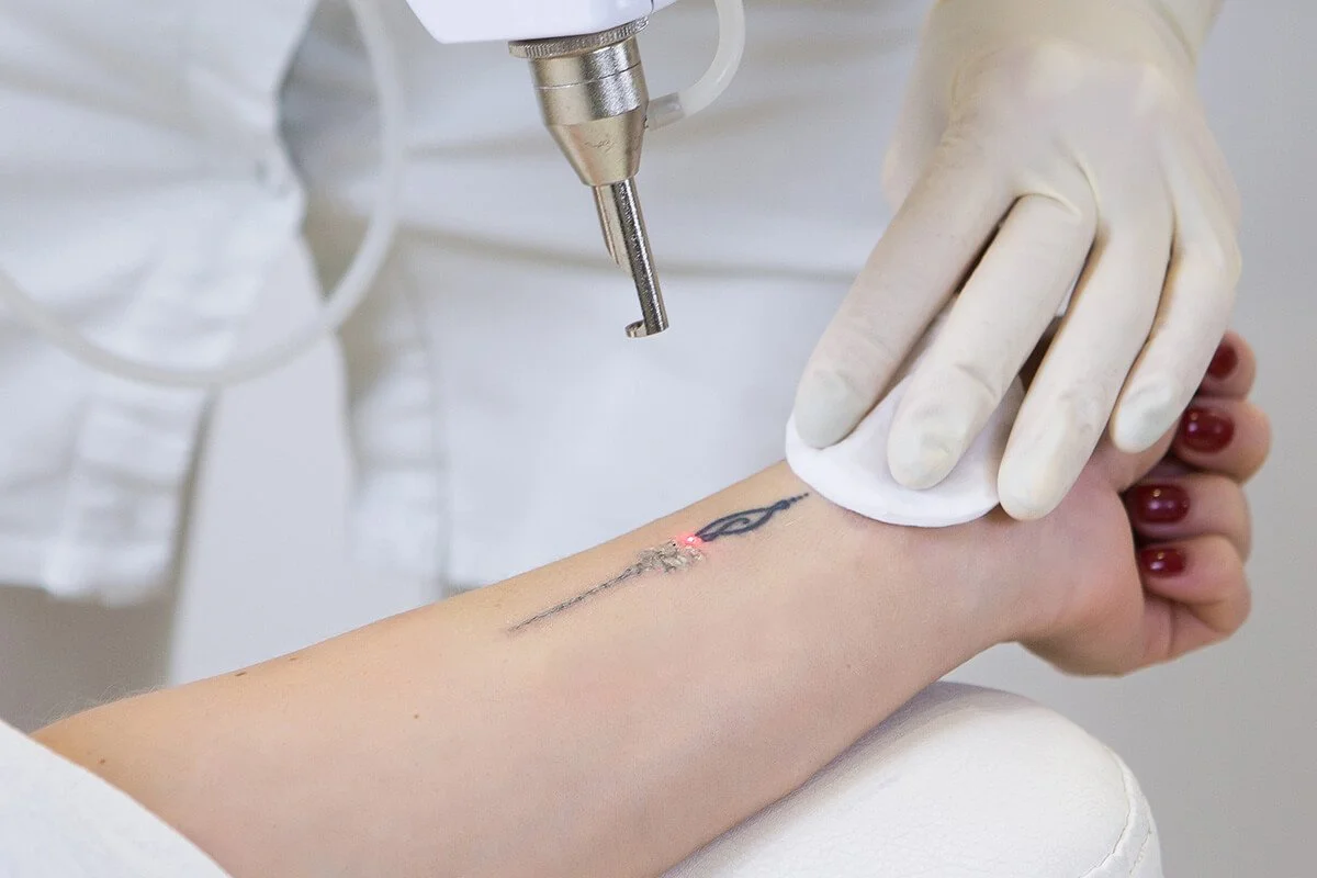 Close-up of a laser device being used on a small wrist tattoo